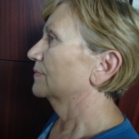 Lifting facial preoperator - lifting facial preoperator