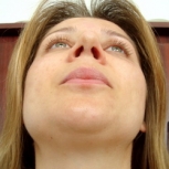 Rinoplastie postoperator - caz 3 - Operatie de corectare a nasului Rinoplastie postoperator