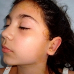 Cura urechilor decolate postoperator - caz 1 - Cura urechilor decolate postoperator - caz 1