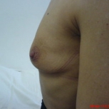 Mamoplastia de augmentare preoperator - caz 5 - Mamoplastia de augmentare preoperator - caz 5