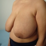 Reducţia mamară preoperator - caz 1 - Reducţia mamară preoperator - caz 1